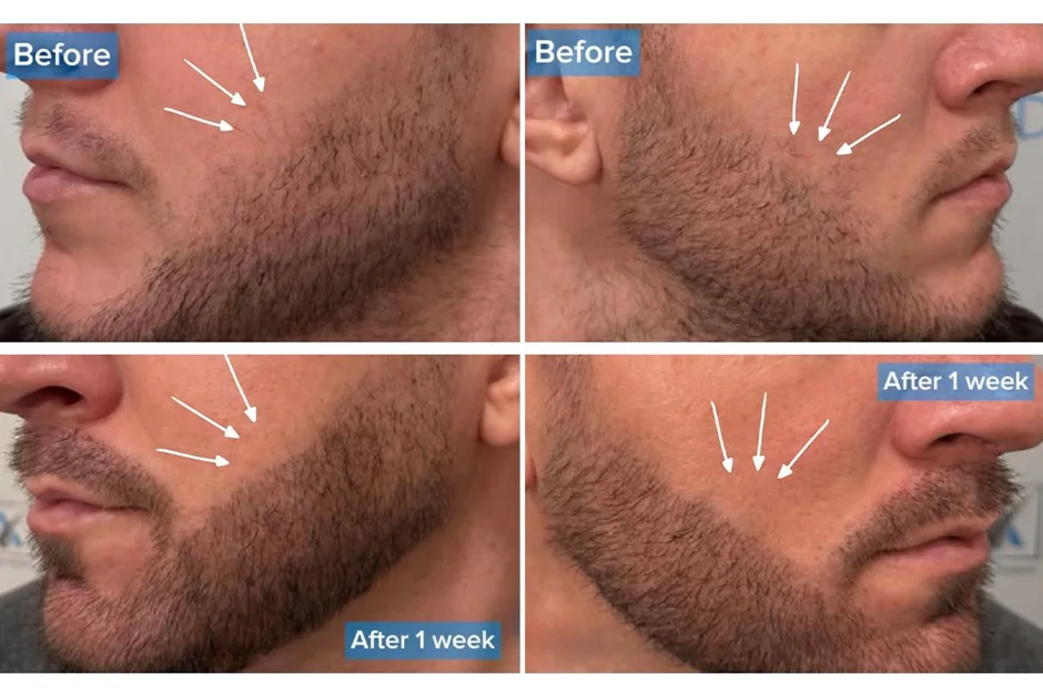 Când imaginea devine parte din brandul personal: implantul de barbă Q-FUE la Dr. Felix Hair Implant din București — Antreprenoriat in miscare